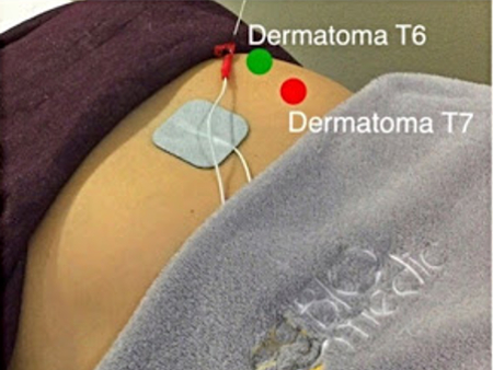 Método Dermatoma T6 y T7